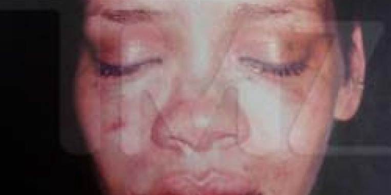 Chris Brown er ekskæreste til sangerinden Rihanna. Her ses hun, efter at Chris Brown bankede hende gul og blå.
