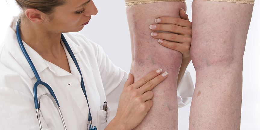 Læge der ser på ben med karsprængninger