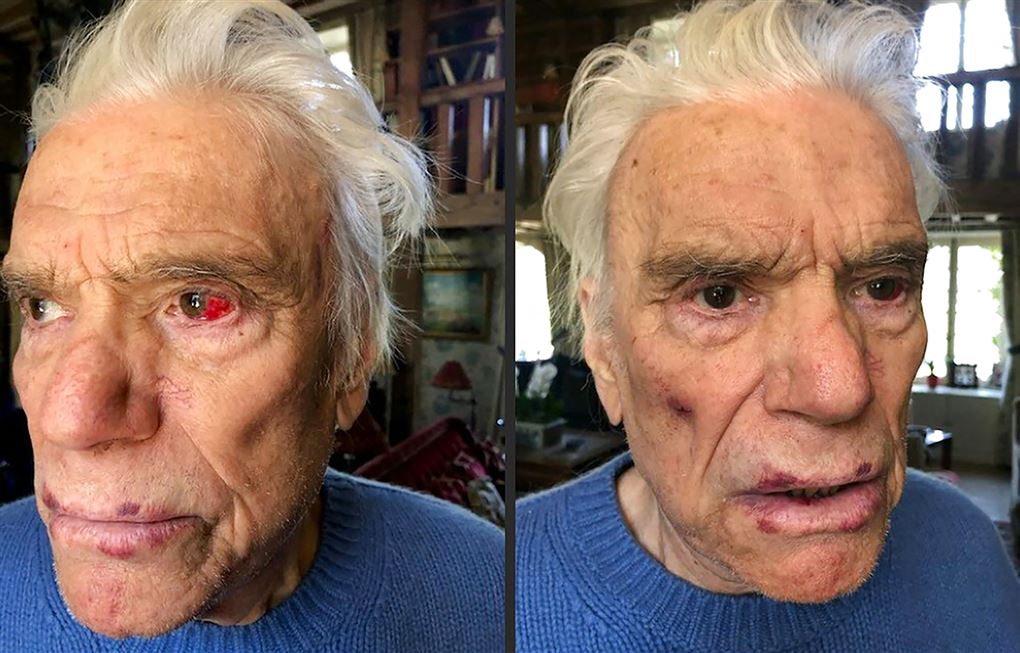 to billeder af en forslået Bernard Tapie