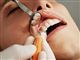 person med åben mund får renset tænder hos tandlægen