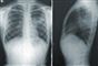 røntgenbilleder af lunger
