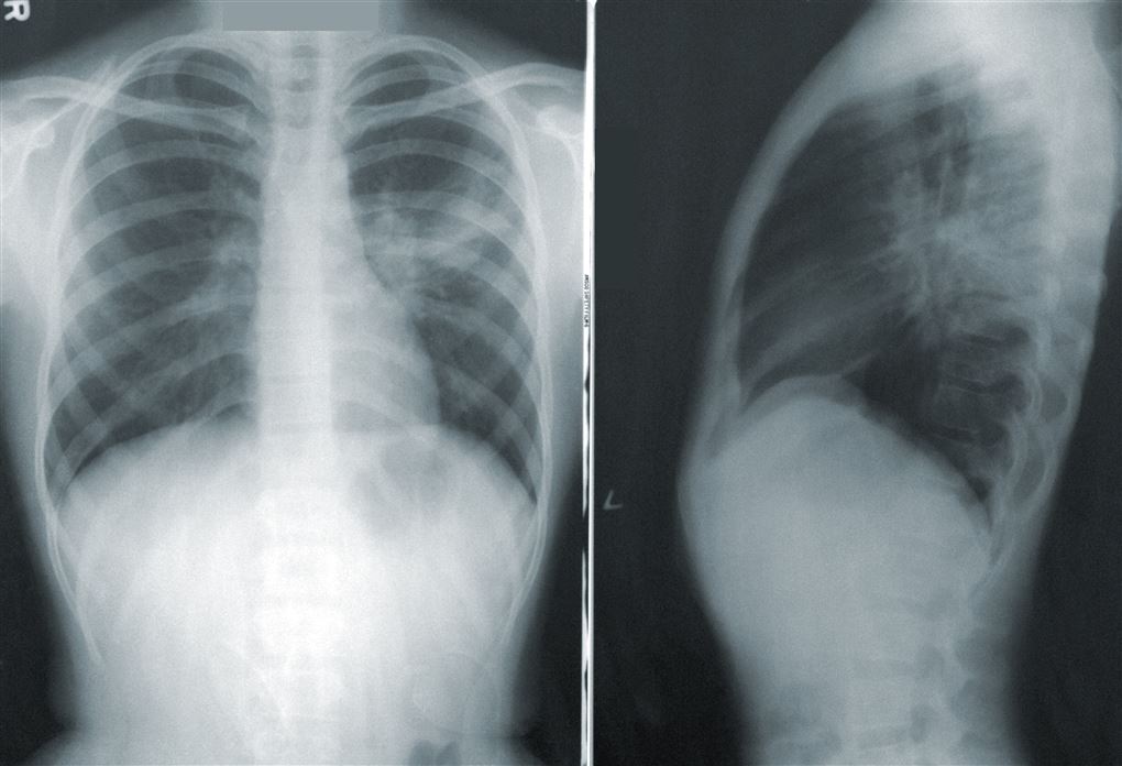 røntgenbilleder af lunger